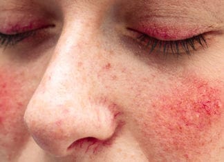 Four Tips to Get Rid of Facial Redness